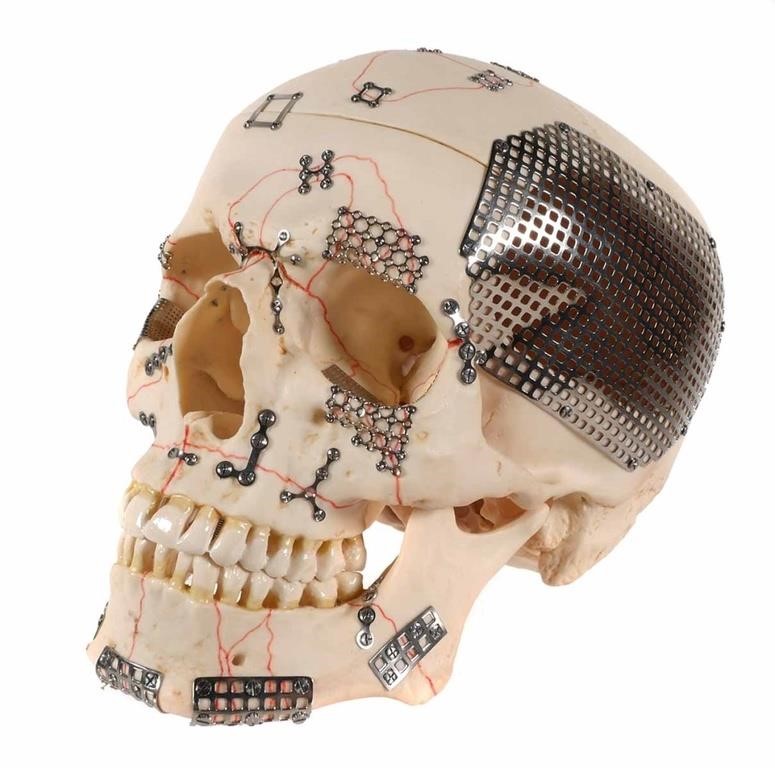 CRANIOPLASTY MEDICAL SKULL SCULPTUREKourosh