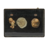 19TH CENTURY WAX MODELS, FETUS