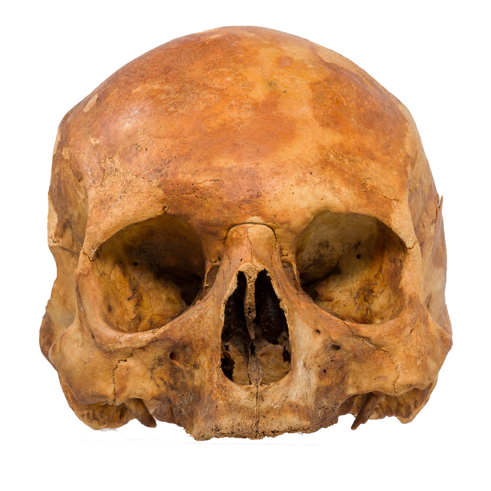 ANTIQUE TREPANATED HUMAN