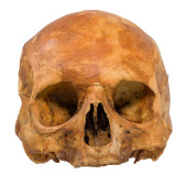 ANTIQUE TREPANATED HUMAN SKULL